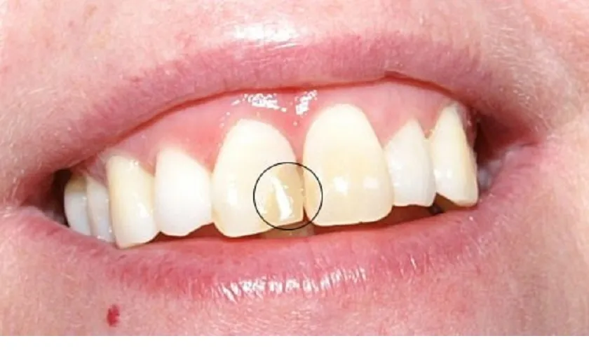 Trám răng cửa bị mẻ giá bao nhiêu