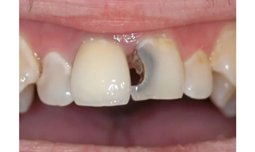 Trám răng cửa bị mẻ và 9 lưu ý bạn nên biết !