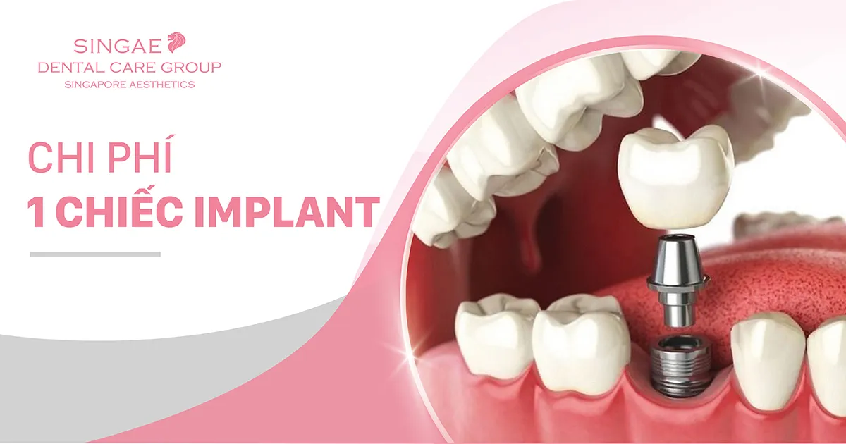 Trồng răng Implant giá bao nhiêu? Bảng giá chi tiết T7/2024