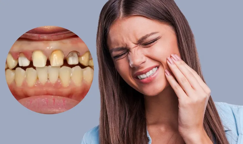 Hậu quả bọc răng sứ