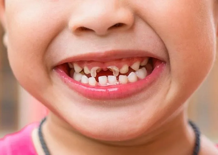 Viêm nướu ảnh hưởng đến răng bên cạnh