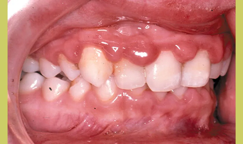Viêm nướu ở trẻ em là bệnh gì