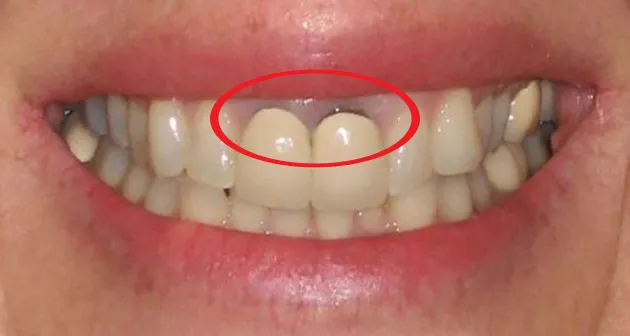 Hậu quả bọc răng sứ