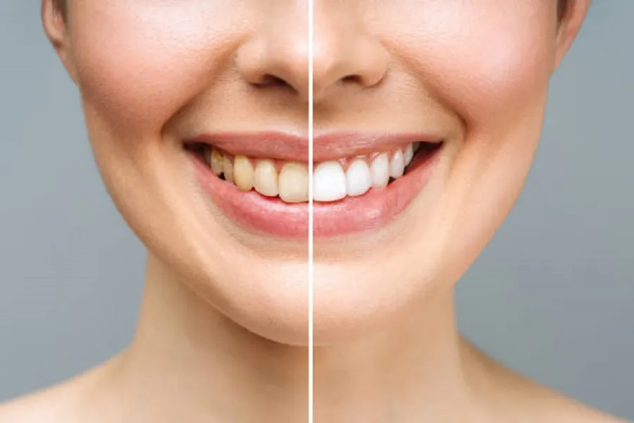 3 Cách làm trắng răng bị ố vàng lâu năm đơn giản tại nhà 5 Cách làm trắng răng bị ố vàng lâu năm