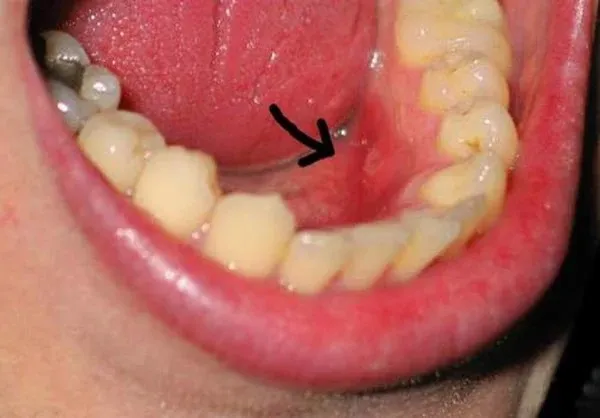 Dấu hiệu nhiễm trùng sau khi nhổ răng khôn bạn nên biết
