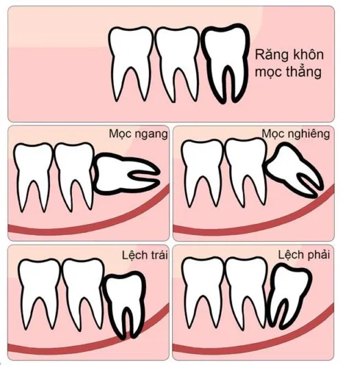 7 Dấu hiệu răng khôn mọc lệch dễ nhận biết