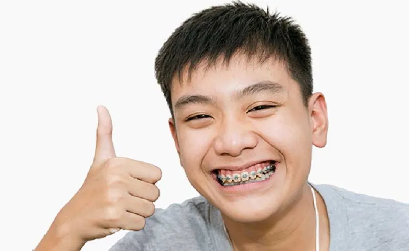 16 tuổi niềng răng bao nhiêu tiền