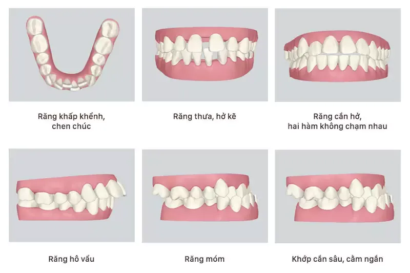 18 tuổi niềng răng bao nhiêu tiền