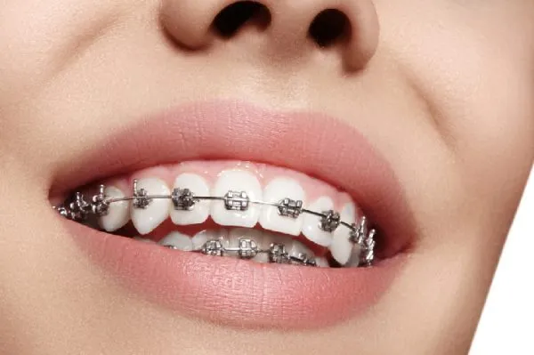 18 tuổi niềng răng được không
