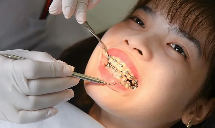 Bắt vít niềng răng là gì? Khi nào cần thực hiện và lưu ý 10 Bắt vít niềng răng có đau không