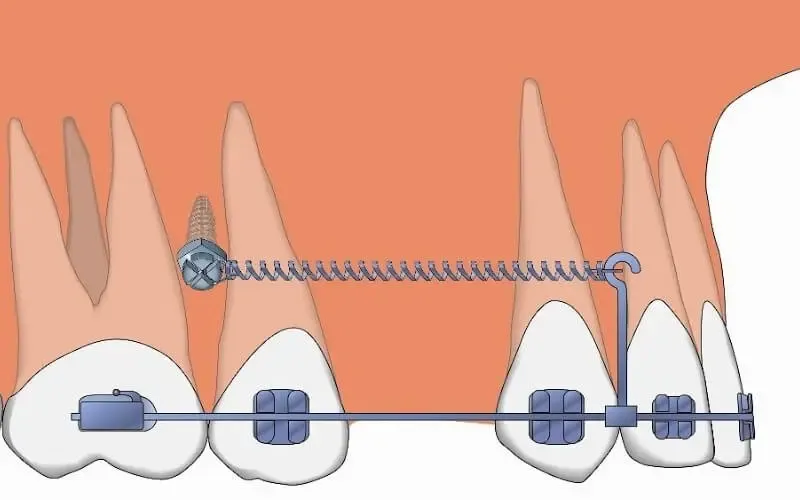 Bắt vít niềng răng là gì? Khi nào cần thực hiện và lưu ý 6 Bắt vít niềng răng