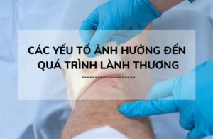 Trồng răng Implant bao lâu thì lành? 3 cách giúp mau lành 15 Các yếu tố ảnh hưởng đến thời gian lành vết thương