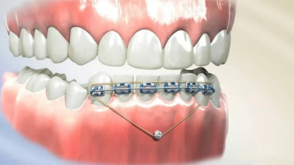 Các yếu tố ảnh hưởng đến thời gian niềng răng