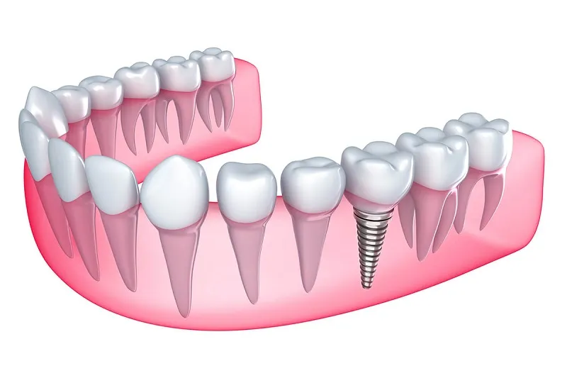 Cấy ghép Implant là gì