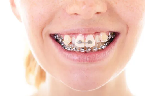 Giai đoạn xấu nhất khi niềng răng