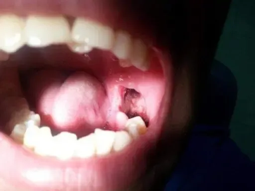 20+ Hình ảnh lợi sau khi nhổ răng và lưu ý giúp mau lành