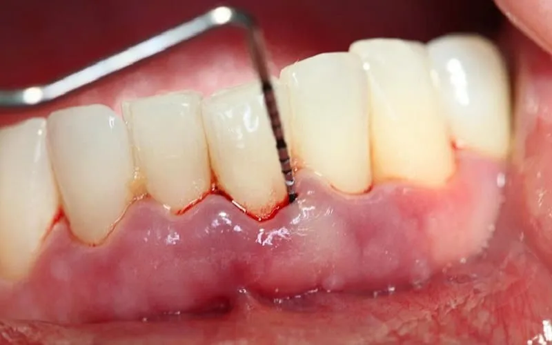 20+ Hình ảnh viêm chân răng dễ nhận biết để sớm điều trị