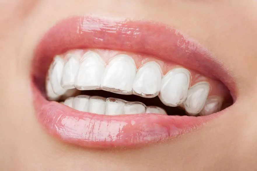 Niềng răng trong suốt Invisalign