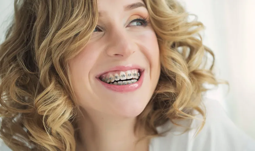 Niềng răng móm có được không? Thời gian và chi phí 7 Lợi ích của việc niềng răng móm
