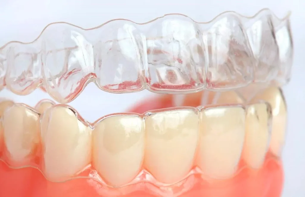 Lý do nên chọn niềng răng bằng khay trong suốt