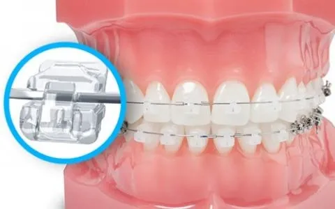 Niềng răng mắc cài tự buộc là gì? Có mấy loại, giá bao nhiêu 8 Mắc cài sứ tự buộc