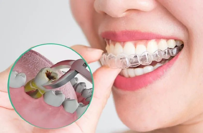 Niềng răng Invisalign – Giải pháp thẩm mỹ nâng cao khi chỉnh nha