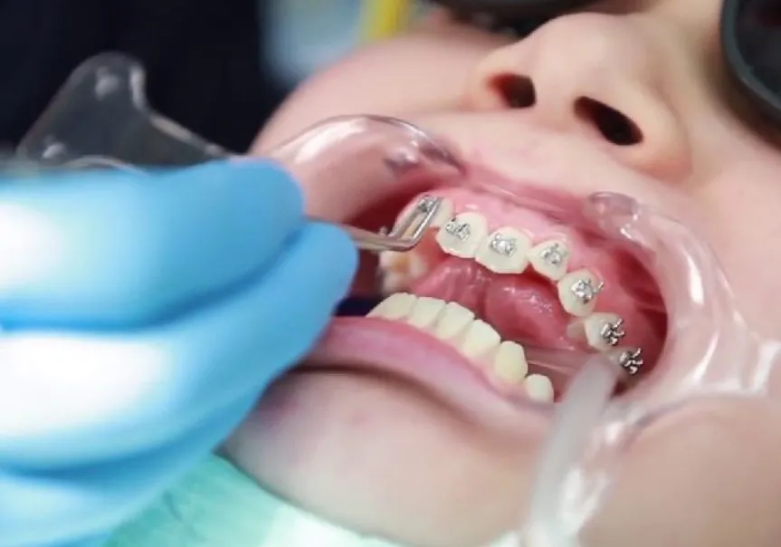 Niềng răng cho trẻ 16 tuổi mất bao lâu