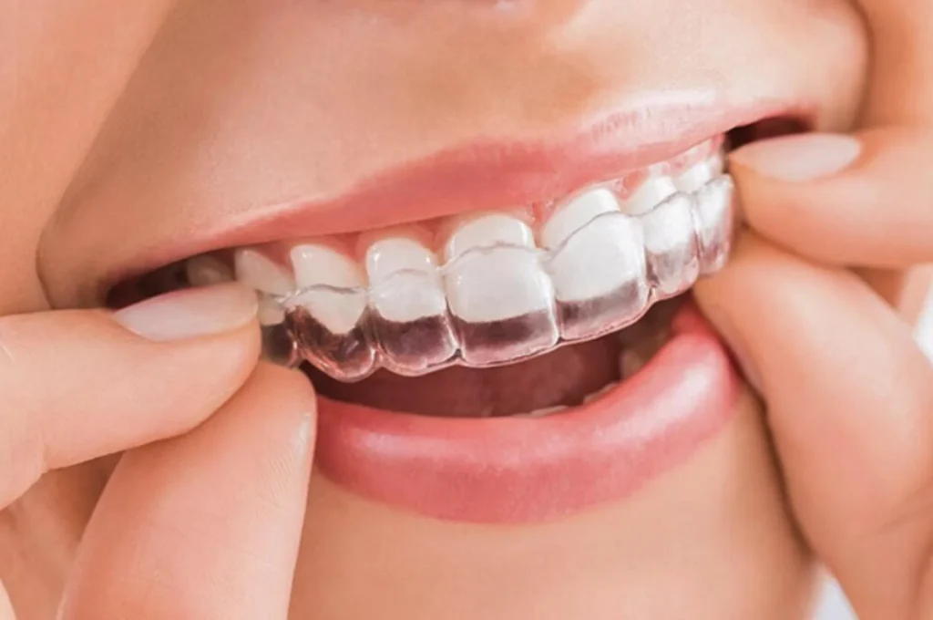 Niềng răng hô bằng khay trong suốt Invisalign