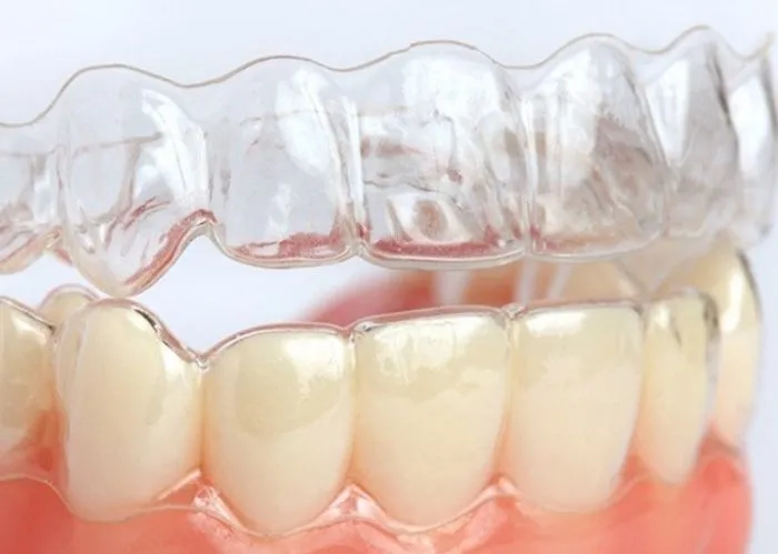 Niềng răng không mắc cài 3D Clear