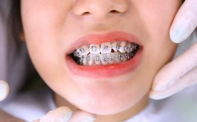 Niềng răng là gì
