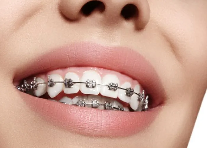 Niềng răng mắc cài kim loại tự buộc