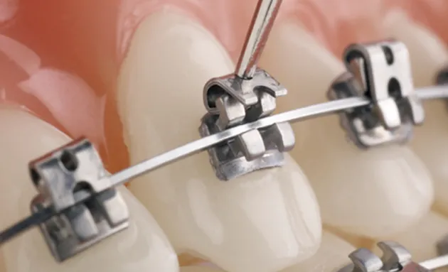 Niềng răng mắc cài kim loại tự buộc mất bao lâu