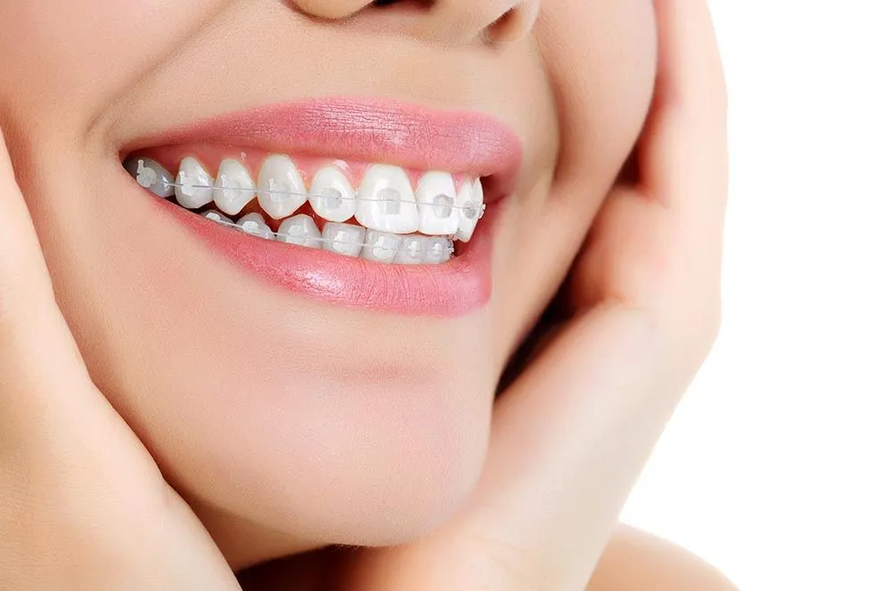 Niềng răng mắc cài pha lê giá bao nhiêu