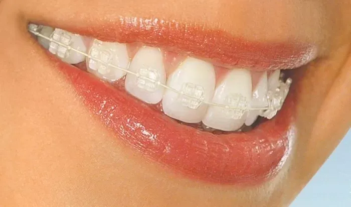 Niềng răng mắc cài pha lê