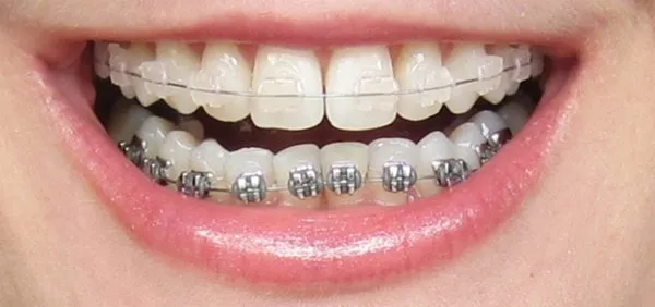 Niềng răng móm có được không? Thời gian và chi phí 8 Niềng răng móm có đau không