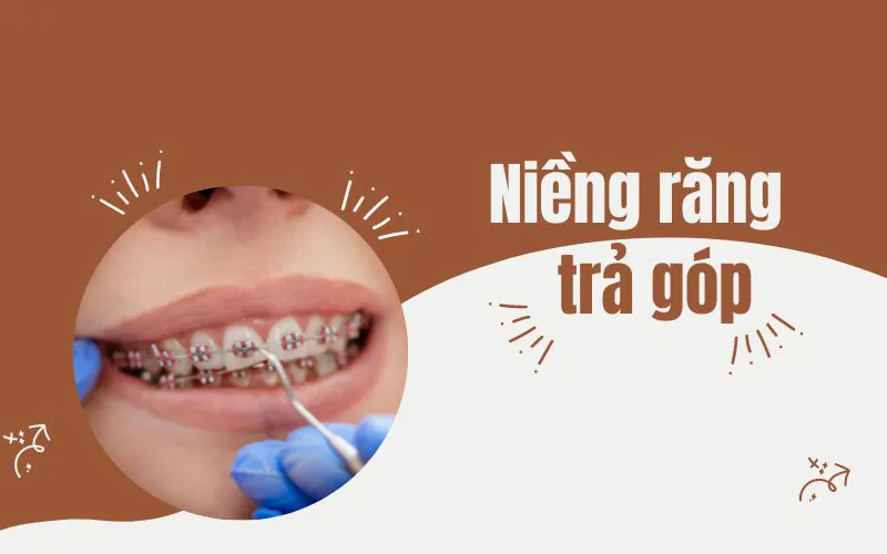 Niềng răng trả góp lãi suất 0%, thủ tục đơn giản tại Nha khoa Singae 21 Niềng răng trả góp