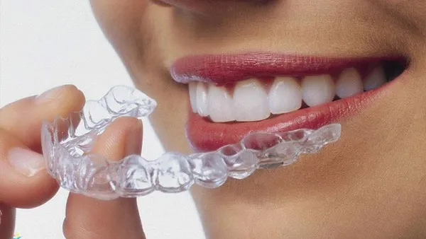 Niềng răng trong suốt là gì