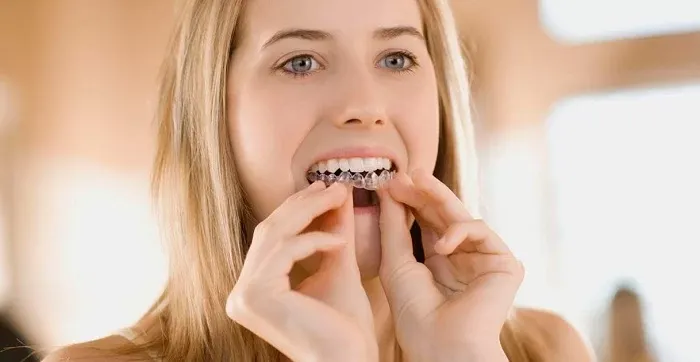 Niềng răng trong suốt mất bao lâu