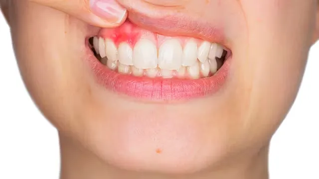 Nướu sưng đỏ khi viêm chân răng