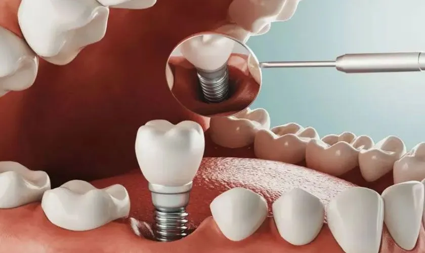 Sau khi nhổ răng bao lâu thì trồng Implant?