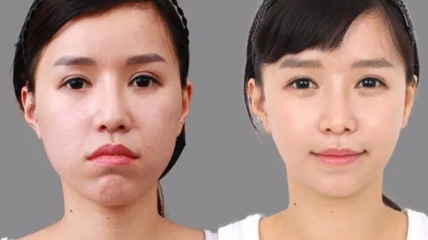 Sự thay đổi của các bộ phận trên khuôn mặt trước và sau khi niềng răng