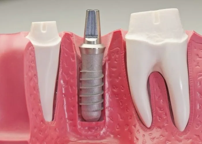 Trồng răng Implant bao lâu thì lành? 3 cách giúp mau lành 11 Thời gian cấy ghép Implant và quá trình phục hồi