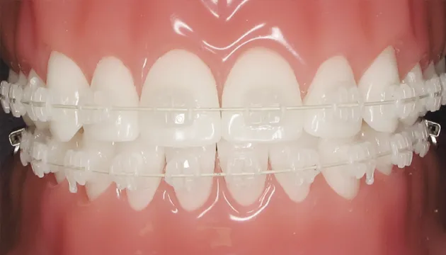 Thời gian niềng răng mắc cài sứ
