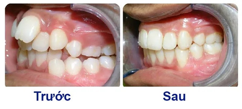 Trước và sau khi niềng răng trường hợp khớp cắn hở