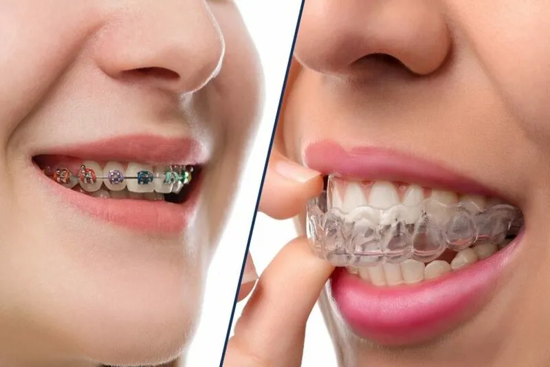Ưu điểm của niềng răng trong suốt