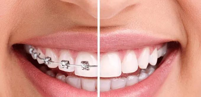 Ưu điểm của phương pháp niềng răng không mắc cài 