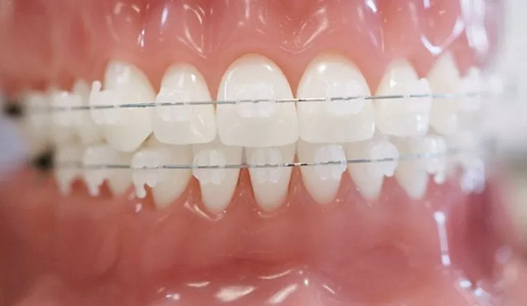 Ưu điểm của phương pháp niềng răng mắc cài pha lê