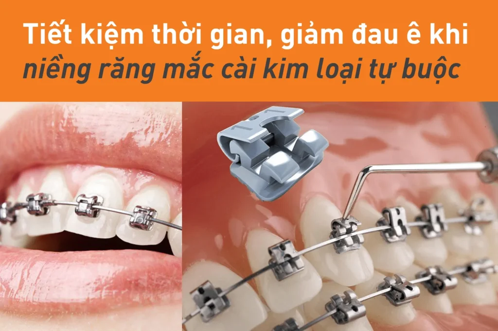 Ưu điểm niềng răng mắc cài kim loại tự buộc