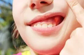 Viêm chân răng có mủ