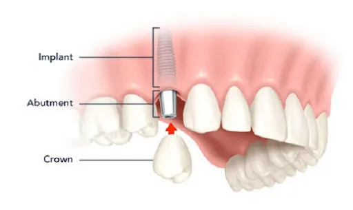 Giải đáp: Khi nào nên trồng răng Implant?